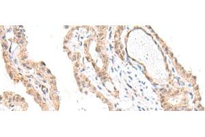 Immunohistochemistry of paraffin-embedded Human thyroid cancer tissue using FANCE Polyclonal Antibody at dilution of 1:50(x200) (FANCE 抗体)
