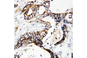 Anti-uPA Receptor antibody, IHC(P) IHC(P): Human Mammary Cancer Tissue (PLAUR 抗体  (C-Term))