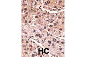 Formalin-fixed and paraffin-embedded human hepatocellular carcinoma tissue reacted with MAGEA12 polyclonal antibody  , which was peroxidase-conjugated to the secondary antibody, followed by AEC staining. (MAGEA12 抗体  (N-Term))