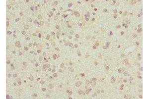 Immunohistochemistry of paraffin-embedded human glioma using ABIN7143513 at dilution of 1:100 (ARL6 抗体  (AA 1-186))