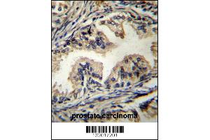 STAMBP Antibody immunohistochemistry analysis in formalin fixed and paraffin embedded human prostate carcinoma followed by peroxidase conjugation of the secondary antibody and DAB staining. (STAMBP 抗体  (C-Term))