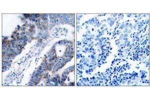 Immunohistochemical analysis of paraffin- embedded human breast carcinoma tissue, using ASK1 (Ab-83) antibody (E021125). (ASK1 抗体)