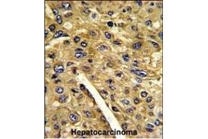 Formalin-fixed and paraffin-embedded human hepatocarcinoma reacted with T Antibody (N-term), which was peroxidase-conjugated to the secondary antibody, followed by DAB staining. (Aminomethyltransferase 抗体  (N-Term))