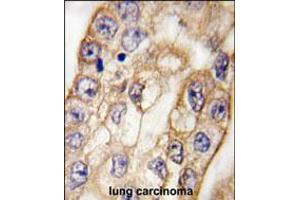Formalin-fixed and paraffin-embedded human lung carcinoma tissue reacted with CD8A antibody , which was peroxidase-conjugated to the secondary antibody, followed by DAB staining. (CD8 alpha 抗体  (C-Term))