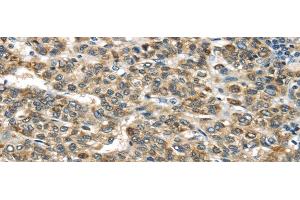 Immunohistochemistry of paraffin-embedded Human liver cancer tissue using TNFAIP2 Polyclonal Antibody at dilution 1:40