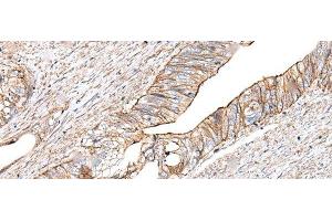 Immunohistochemistry of paraffin-embedded Human colorectal cancer tissue using BLVRB Polyclonal Antibody at dilution of 1:65(x200) (BLVRB 抗体)