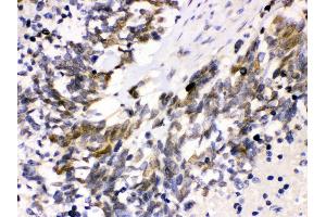 Anti- Cdk4 Picoband antibody, IHC(P) IHC(P): Human Lung Cancer Tissue (CDK4 抗体  (AA 201-303))