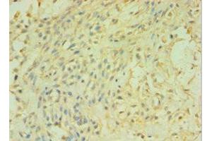 Immunohistochemistry of paraffin-embedded human breast cancer using ABIN7146501 at dilution of 1:100