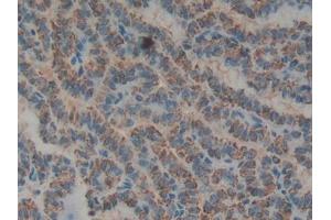 DAB staining on IHC-P; Samples: Human Thyroid cancer Tissue (Biglycan 抗体  (AA 48-158))