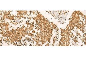 Immunohistochemistry of paraffin-embedded Human lung cancer tissue using EFTUD2 Polyclonal Antibody at dilution of 1:45(x200) (EFTUD2 抗体)