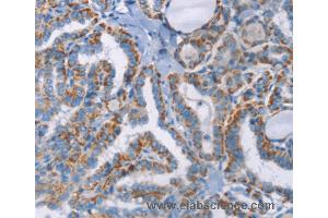 Immunohistochemistry of Human thyroid cancer using GPA33 Polyclonal Antibody at dilution of 1:30 (GPA33 抗体)