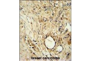 ITIH5 Antibody (C-term) (ABIN654918 and ABIN2844563) immunohistochemistry analysis in formalin fixed and paraffin embedded human breast carcinoma followed by peroxidase conjugation of the secondary antibody and DAB staining. (ITIH5 抗体  (C-Term))