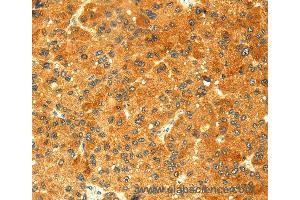Immunohistochemistry of Human colon cancer using GK Polyclonal Antibody at dilution of 1:60