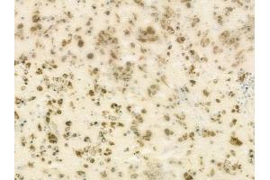 ABIN6264449 and ABIN6273150 at 1/100 staining human melanoma by IHC-P. (PRPF8 抗体  (C-Term))
