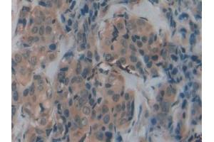 Detection of TFR2 in Human Breast cancer Tissue using Polyclonal Antibody to Transferrin Receptor 2 (TFR2) (Transferrin Receptor 2 抗体  (AA 211-405))