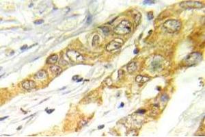 Immunohistochemistry (IHC) analyzes of ERK1/2 antibody in paraffin-embedded human breast carcinoma tissue. (ERK1/2 抗体)