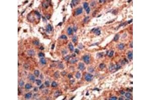 IHC analysis of FFPE human breast carcinoma tissue stained with the ALK3 antibody (BMPR1A 抗体  (AA 30-60))