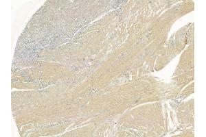 ABIN6266234 and ABIN6277388 at 1/100 staining human tongue carcinoma by IHC-P.