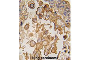 Formalin-fixed and paraffin-embedded human lung carcinomareacted with Tlr6 polyclonal antibody , which was peroxidase-conjugated to the secondary antibody, followed by AEC staining.