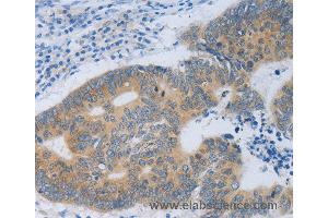 Immunohistochemistry of Human colon cancer using MT2A Polyclonal Antibody at dilution of 1:40 (MT2A 抗体)