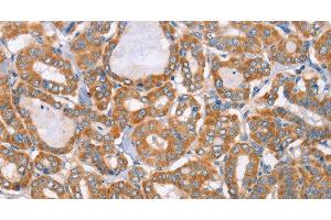 Immunohistochemistry of paraffin-embedded Human thyroid cancer tissue using MTMR7 Polyclonal Antibody at dilution 1:40 (MTMR7 抗体)