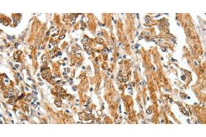 Immunohistochemistry of paraffin-embedded Human gastric cancer tissue using TGF β Receptor I Polyclonal Antibody at dilution 1:60