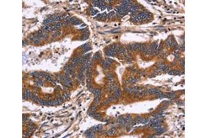 Immunohistochemical analysis of paraffin-embedded Human colon cancer tissue using at dilution 1/30. (KIR2DL3 抗体  (Internal Region))