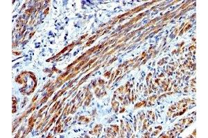 Formalin-fixed, paraffin-embedded human Leiomyosarcoma stained with SMMHC antibody (MYH11/923). (MYH11 抗体)