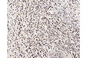 Immunohistochemistry analysis of paraffin-embedded human lung cancer using c-Fos Polyclonal Antibody at dilution of 1:200. (c-FOS 抗体)