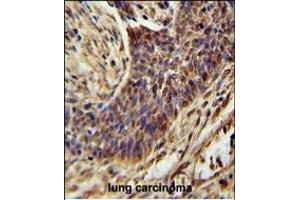 ZSWIM1 Antibody (C-term) (ABIN654558 and ABIN2844265) immunohistochemistry analysis in formalin fixed and paraffin embedded human lung carcinoma followed by peroxidase conjugation of the secondary antibody and DAB staining. (ZSWIM1 抗体  (C-Term))