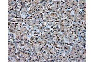 Immunohistochemical staining of paraffin-embedded Adenocarcinoma of colon tissue using anti-APP mouse monoclonal antibody. (APP 抗体)