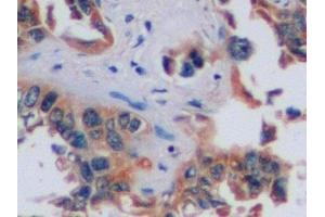 Detection of CA9 in Human Lung cancer Tissue using Polyclonal Antibody to Carbonic Anhydrase IX (CA9) (CA9 抗体  (AA 59-414))