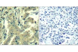 Immunohistochemical analysis of paraffin-embedded human lung carcinoma tissue using PLC-γ2 (Ab-1217) Antibody (E021524). (Phospholipase C gamma 2 抗体)