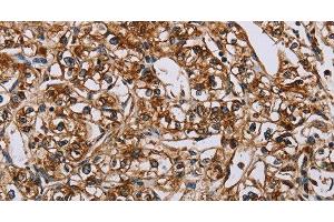 Immunohistochemistry of paraffin-embedded Human prostate cancer using BMP6 Polyclonal Antibody at dilution of 1:50 (BMP6 抗体)