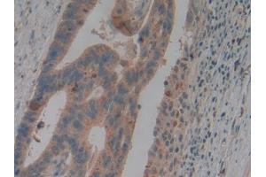 Detection of NGAL in Human Colorectal cancer Tissue using Polyclonal Antibody to Neutrophil gelatinase-associated lipocalin (NGAL)