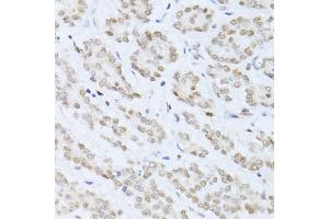 Immunohistochemistry of paraffin-embedded human colon carcinoma using SIRT1 antibody (ABIN6291361) at dilution of 1:100 (40x lens). (SIRT1 抗体)