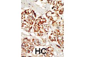 Formalin-fixed and paraffin-embedded human hepatocellular carcinoma tissue reacted with KSR1 polyclonal antibody  , which was peroxidase-conjugated to the secondary antibody, followed by DAB staining. (KSR1 抗体  (N-Term))