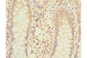 Immunohistochemistry of paraffin-embedded human colon cancer using ABIN7158982 at dilution of 1:100 (MPI 抗体  (AA 1-423))
