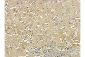 ABIN6262599 and ABIN6273256 at 1/100 staining human pancreatic carcinoma by IHC-P. (INSIG1 抗体  (Internal Region))