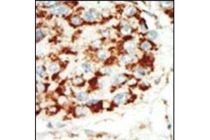 Formalin-fixed and paraffin-embedded human cancer tissue reacted with the primary antibody, which was peroxidase-conjugated to the secondary antibody, followed by AEC staining. (PRKAB1 抗体  (N-Term))