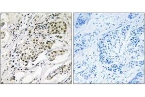 Immunohistochemistry analysis of paraffin-embedded human breast carcinoma, using CDYL2 Antibody. (CDYL2 抗体  (AA 31-80))