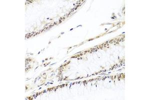 Immunohistochemistry of paraffin-embedded human colon carcinoma using HIRA antibody (ABIN6128018, ABIN6141776, ABIN6141778 and ABIN6224528) at dilution of 1:100 (40x lens). (HIRA 抗体  (AA 250-550))