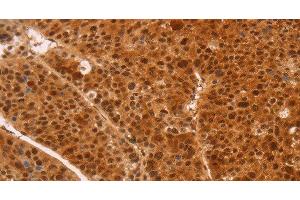 Immunohistochemistry of paraffin-embedded Human liver cancer tissue using HEXIM1 Polyclonal Antibody at dilution 1:65 (HEXIM1 抗体)