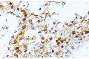 Immunohistochemistry of paraffin-embedded Human breast cancer using PRMT1 Polyclonal Antibody at dilution of 1:100 (40x lens). (PRMT1 抗体)