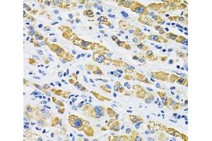 Immunohistochemistry of paraffin-embedded Human liver cancer using SLC16A4 Polyclonal Antibody at dilution of 1:100 (40x lens). (SLC16A4 抗体)