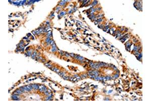 The image on the left is immunohistochemistry of paraffin-embedded Human colon cancer tissue using ABIN7129022(COX8A Antibody) at dilution 1/12, on the right is treated with fusion protein. (COX8A 抗体)