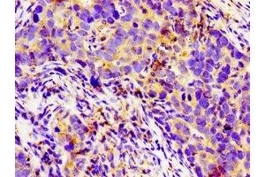 Immunohistochemistry of paraffin-embedded human pancreatic cancer using ABIN7158134 at dilution of 1:100 (LGR6 抗体  (AA 839-962))