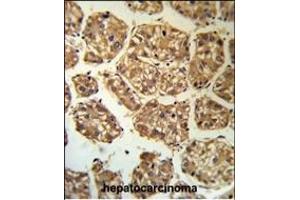 BLNK Antibody (Center) (R) IHC analysis in formalin fixed and paraffin embedded human hepatocarcinoma followed by peroxidase conjugation of the secondary antibody and DAB staining. (B-Cell Linker 抗体  (AA 150-178))