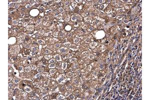 IHC-P Image Albumin antibody detects Albumin protein at cytoplasm in human hepatocellular carcinoma by immunohistochemical analysis. (Albumin 抗体  (C-Term))