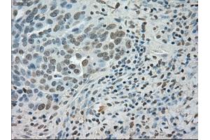 Immunohistochemical staining of paraffin-embedded Adenocarcinoma of colon tissue using anti-SATB1mouse monoclonal antibody. (SATB1 抗体)